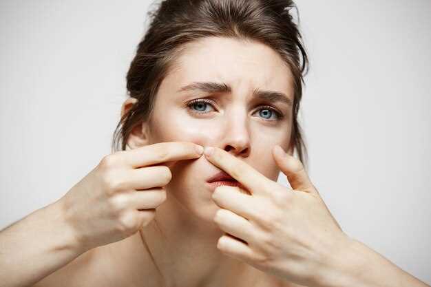 Как не повредить кожу при выдавливании прыща на носу
