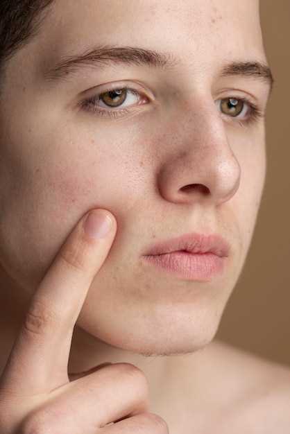 Что такое нарывы на лице и как их лечить: