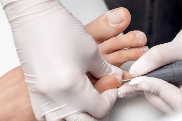 Как избежать появления белых полосок на ногтях?